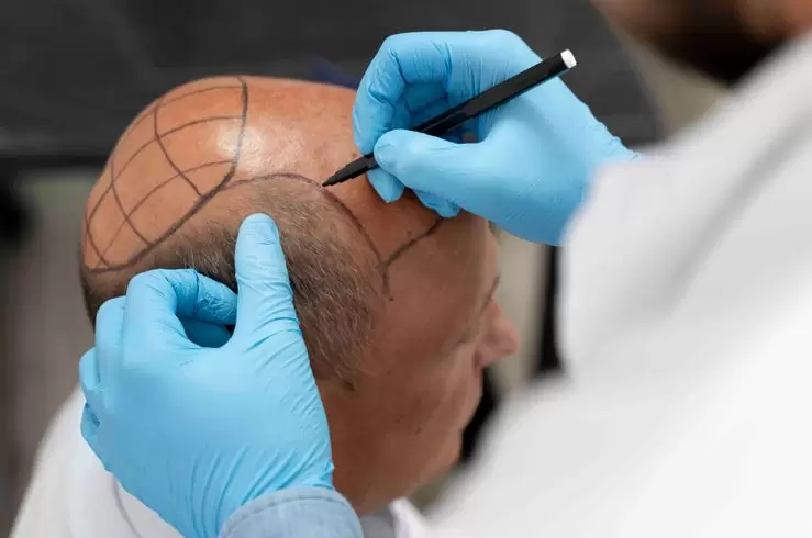 Implante ou transplante capilar? Entenda as principais diferenças