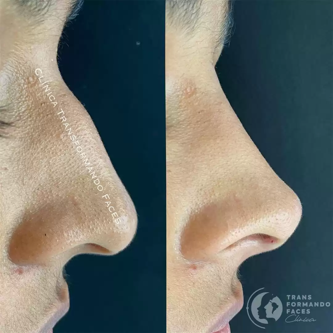 Rinomodelação: conheça o procedimento com ácido hialurônico que modifica o nariz sem apelar para o bisturi
