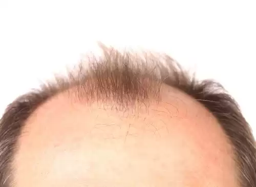 Se meu pai é careca, eu vou ser careca também?