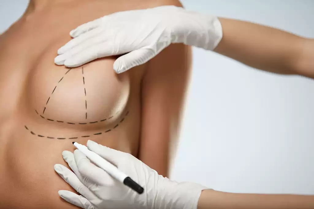 Sling & Short Scar: as novas técnicas de mastopexia deixam cicatrizes menores 